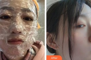 福州秀清醫(yī)療美容診所何卉整形價格表附激光美膚激光案例展示