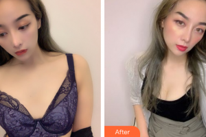 廣州華醫(yī)醫(yī)療美容門診部鄒大維整形價(jià)格表附自體脂肪隆胸案例展示