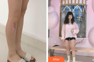 廣州基立嘉韓醫(yī)學(xué)整形美容醫(yī)院林彩環(huán)整形價(jià)格表附增生疤痕案例展示