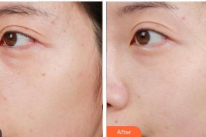 福州秀清醫(yī)療美容診所繆水云整形價(jià)格表附激光美膚祛斑案例展示