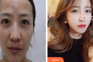 廣州基立嘉韓醫(yī)學(xué)整形美容醫(yī)院杜欣逸整形價(jià)格表附自體脂肪全臉填充案例展示