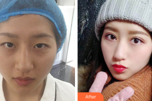 廣州基立嘉韓醫(yī)學(xué)整形美容醫(yī)院劉朝忠整形價(jià)格表附眼部綜合案例展示