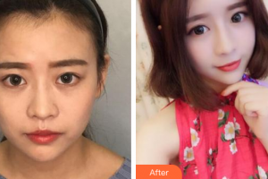 廣州基立嘉韓醫(yī)學(xué)整形美容醫(yī)院吳紅整形價(jià)格表附熱瑪吉多方面部案例展示