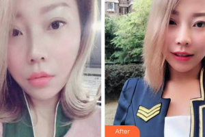 廣州醫(yī)學(xué)院口腔醫(yī)院樸正國整形價(jià)格表附牙齒隱形矯正案例展示