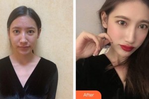 福州海峽美容醫(yī)院呂劍昇整形價格表附鼻部手術(shù)案例展示