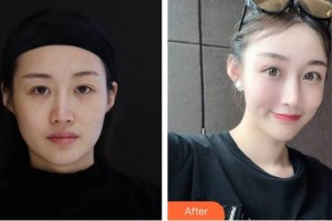 福州格萊美醫(yī)療美容醫(yī)院官玉貞整形價格表附熱瑪吉抗衰案例展示