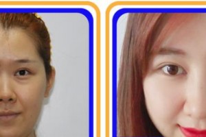 福州美貝爾醫(yī)療美容門診部羅德豐整形價格表附眼部綜合案例展示