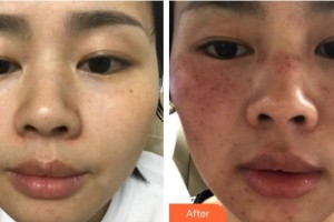 福州愛思特醫(yī)療美容醫(yī)院鄭榕整形價格表附超激光美膚案例展示