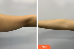 福州格萊美醫(yī)療美容醫(yī)院陳陽整形價格表附手臂吸脂案例展示