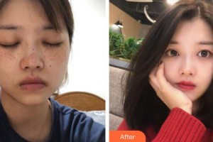 福州臺江醫(yī)院整形美容中心李江麗整形價格表附激光美膚案例展示