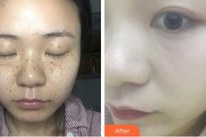 福州愛思特比華利整形美容醫(yī)院李燕華整形價格表附超激光美膚祛斑案例展示