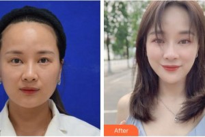 福州市第八人民醫(yī)院整形美容科索南多杰整形價格表附埋線提升案例展示