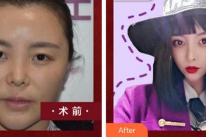 福州名韓整形美容醫(yī)院宋潤相整形價格表附鼻部手術(shù)案例展示