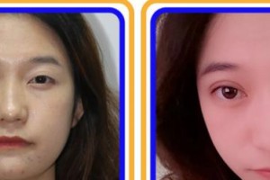 福州市第八人民醫(yī)院整形美容科陳雄整形價格表附眼部綜合案例展示