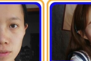 福州藝美醫(yī)療整形美容診所廖國良整形價格表附眼部手術(shù) 案例展示