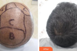 福州百紜凱曼醫(yī)療整形門診部張學(xué)進整形價格表附頭發(fā)種植案例展示