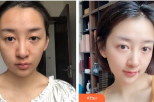 福州美貝爾醫(yī)療美容門診部姍整形價格表附埋線提升提升案例展示