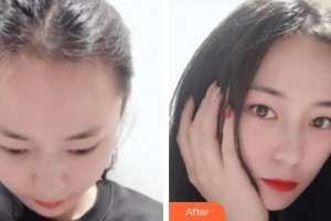 福州格萊美醫(yī)療美容醫(yī)院黃興勇整形價格表附發(fā)際線案例展示