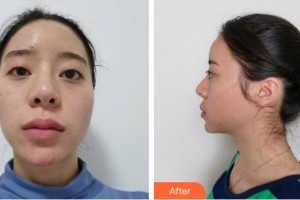 福州海峽美容醫(yī)院羅杰東整形價格表附眼部案例展示