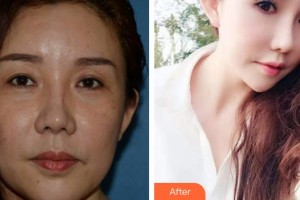 福州優(yōu)美醫(yī)療美容診所高祥整形價格表附眼周年輕化案例展示