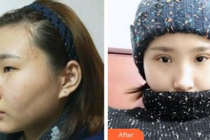 福州中聯(lián)美康整形美容醫(yī)院崔相哲整形價(jià)格表附眼部綜合案例展示