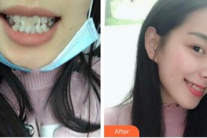 福州海峽美容醫(yī)院章至甫整形價(jià)格表附牙齒矯正案例展示