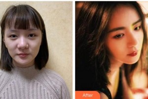 福州海峽美容醫(yī)院何俊杰整形價格表附肋軟骨隆鼻案例展示