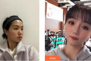 福州海峽美容醫(yī)院王強整形價格表附埋線提升提升案例展示