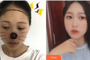 福州海峽美容醫(yī)院廖小飛整形價格表附植發(fā)案例展示