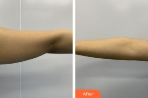 福州海峽美容醫(yī)院蔡玉蕊整形價格表附吸脂案例展示