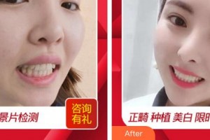 福州華窈渙美整形美容醫(yī)院張文洪整形價格表附牙齒做美容案例展示