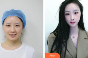 福州名韓整形美容醫(yī)院陳藝清整形價格表附眼部整形案例展示