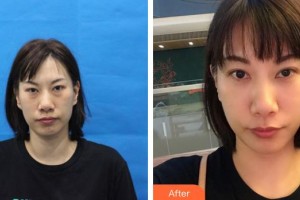 福州市鼓樓醫(yī)院整形美容中心張晘理整形價格表附眼部手術案例展示