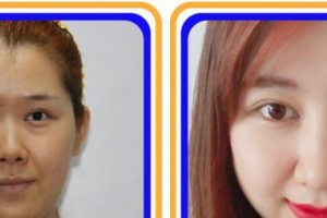 福州維多利亞醫(yī)療美容醫(yī)院陳玉葉整形價格表附眼部手術(shù)案例展示