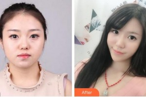 福州格萊美醫(yī)療美容醫(yī)院朱桂香整形價格表附埋線提升案例展示