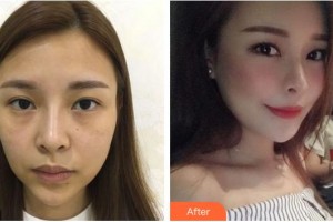 福州格萊美醫(yī)療美容醫(yī)院李橋蓮整形價格表附胸部案例展示