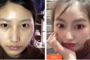 福州美貝爾醫(yī)療美容門診部趙棟材整形價格表附全切雙眼皮案例展示