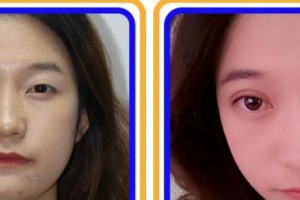 福州美貝爾醫(yī)療美容門診部薛欣整形價格表附眼部綜合案例展示