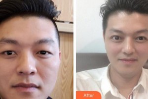 福州美貝爾醫(yī)療美容門診部張曉棠整形價格表附即變男神，無關痛癢案例展示