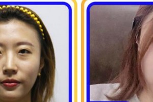 福州格萊美醫(yī)療美容醫(yī)院吳昌炎整形價格表附鼻部手術案例展示