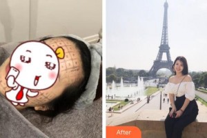 福州格萊美醫(yī)療美容醫(yī)院張鳳整形價格表附抗皺案例展示