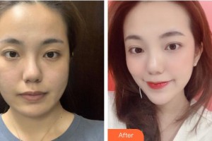 福州格萊美醫(yī)療美容醫(yī)院曹泓整形價格表附抗衰案例展示