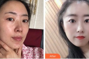 福州名韓整形美容醫(yī)院彭鳳嬌整形價格表附激光美膚激光案例展示