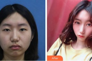 福州名韓整形美容醫(yī)院林偉整形價格表附美眼部手術(shù)案例展示