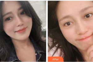 福州艾尚美醫(yī)療美容門診部楊堅整形價格表附熱瑪吉案例展示