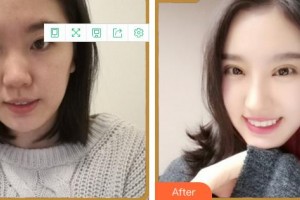 福州眼科醫(yī)院陳大復整形價格表附眼部手術案例展示