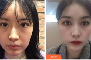 福州眼科醫(yī)院何建忠整形價格表附眼部手術案例展示