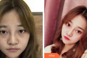 福州眼科醫(yī)院王崢整形價格表附眼部手術案例展示