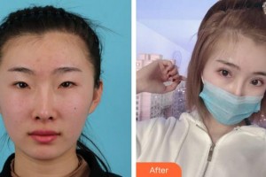 福州眼科醫(yī)院李青整形價格表附雙眼皮案例展示