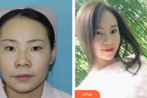 福州眼科醫(yī)院陳平整形價格表附雙眼皮案例展示